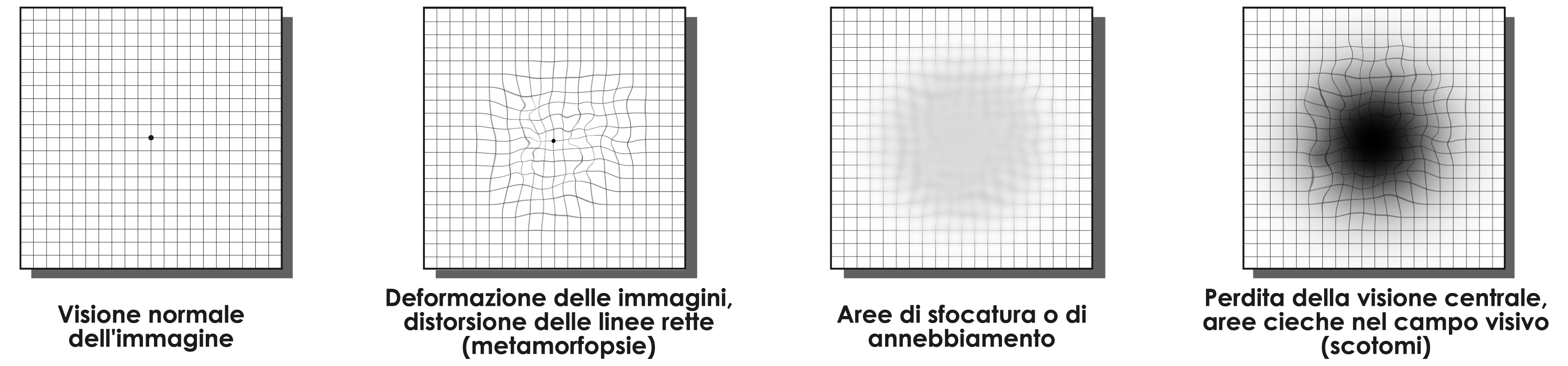 Degenerazione Maculare Legata all’Età